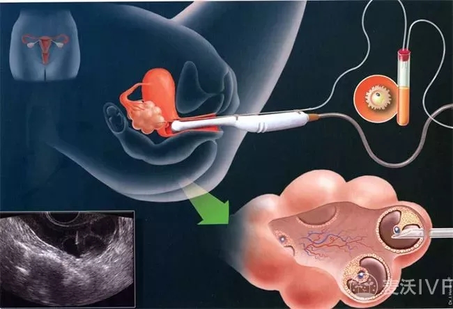 美国试管婴儿：胚胎移植成功的几率是多少