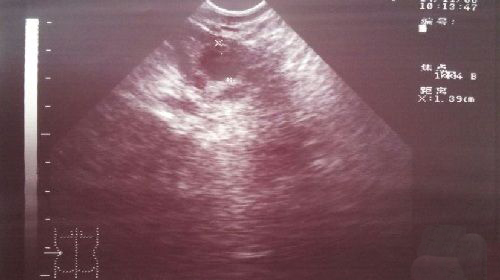 爱之晶海外试管名称解释——卵泡监测