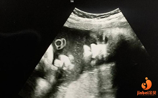 第三代试管婴儿_1