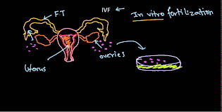 第三代试管婴儿_2