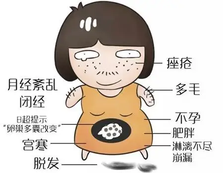 多囊卵巢综合征.png 多囊卵巢综合征.png